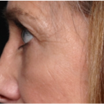 Blepharoplasty Before & After Patient #31420