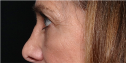 Blepharoplasty Before & After Patient #31420