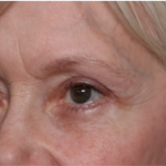 Blepharoplasty Before & After Patient #31443