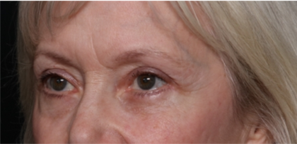 Blepharoplasty Before & After Patient #31443