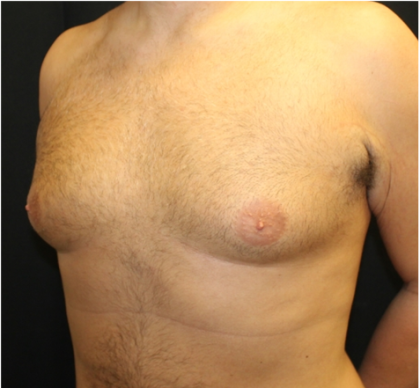 Gynecomastia Before & After Patient #31387
