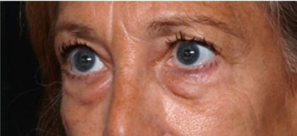 Blepharoplasty Before & After Patient #31420