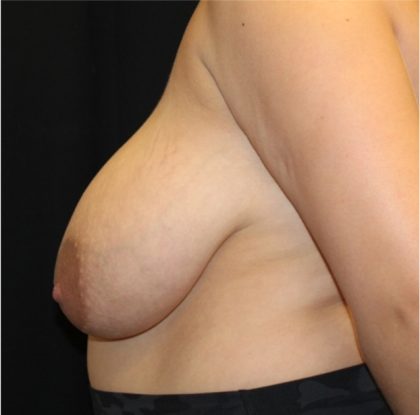 Breast Reduction Before & After Patient #31474