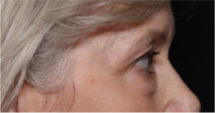 Blepharoplasty Before & After Patient #31443