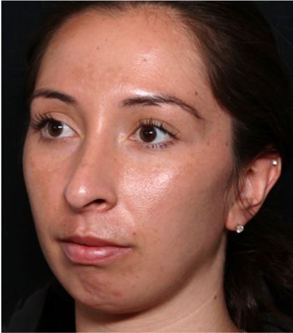 Chin Augmentation Before & After Patient #31453