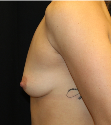 Breast Lift Before & After Patient #31376