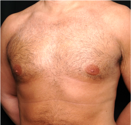 Gynecomastia Before & After Patient #31387