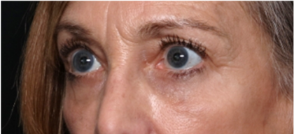 Blepharoplasty Before & After Patient #31420