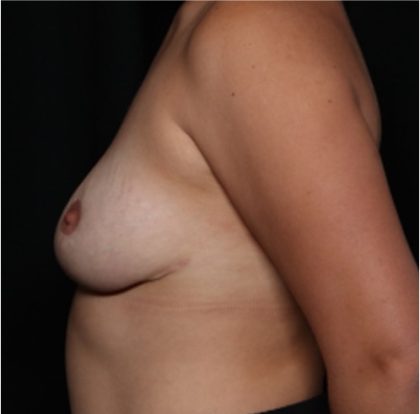 Breast Reduction Before & After Patient #31474