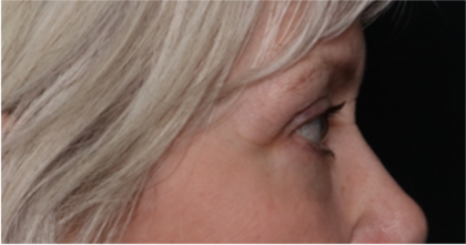 Blepharoplasty Before & After Patient #31443