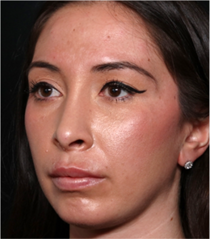 Chin Augmentation Before & After Patient #31453