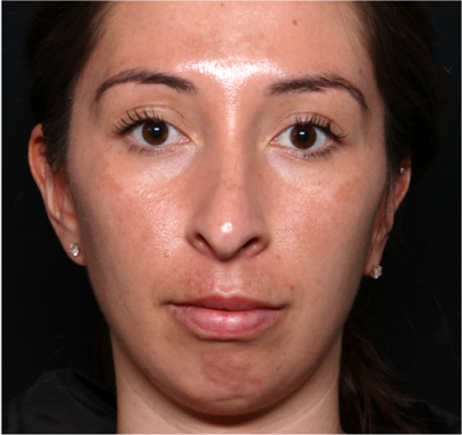 Chin Augmentation Before & After Patient #31453