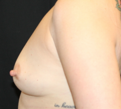 Breast Augmentation Before & After Patient #31486