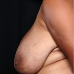 Breast Reduction Before & After Patient #31463