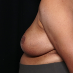 Breast Reduction Before & After Patient #31463