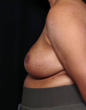 Breast Reduction Before & After Patient #31463