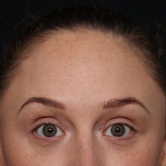 Botox and Dysport Before & After Patient #31429