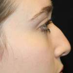 Rhinoplasty Before & After Patient #31578