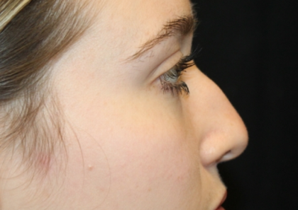 Rhinoplasty Before & After Patient #31578