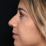 Rhinoplasty Before & After Patient #31701