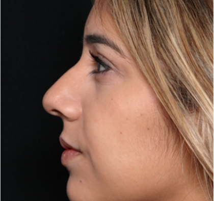 Rhinoplasty Before & After Patient #31701