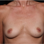 Breast Augmentation Before & After Patient #31714