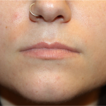 Lip Filler Before & After Patient #31732