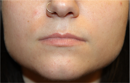 Lip Filler Before & After Patient #31732