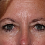 Blepharoplasty and Brow Lift Before & After Patient #31497