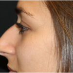 Rhinoplasty Before & After Patient #31744