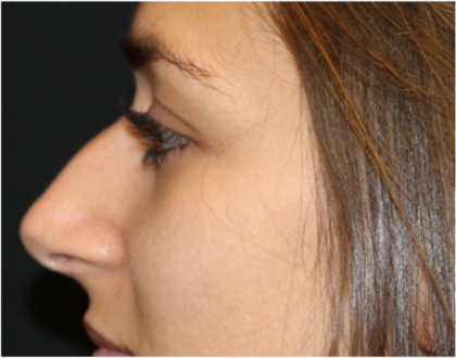 Rhinoplasty Before & After Patient #31744