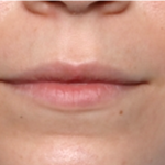 Lip Filler Before & After Patient #31757