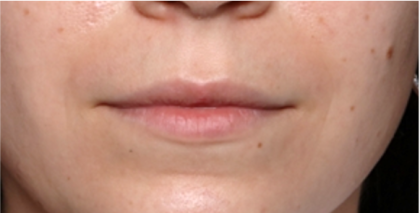 Lip Filler Before & After Patient #31757