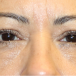 Blepharoplasty and Brow Lift Before & After Patient #31590