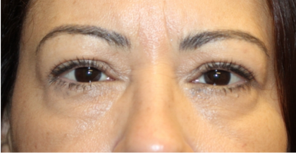 Blepharoplasty and Brow Lift Before & After Patient #31590