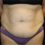 Tummy Tuck Before & After Patient #31832