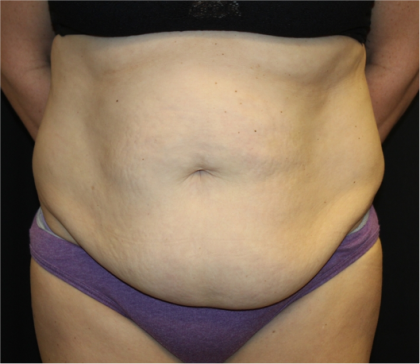 Tummy Tuck Before & After Patient #31832