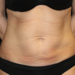 Tummy Tuck Before & After Patient #31601