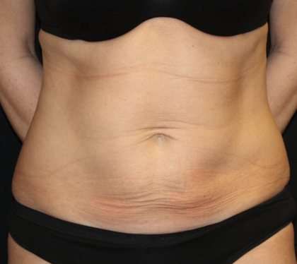 Tummy Tuck Before & After Patient #31601