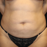 Tummy Tuck Before & After Patient #31639