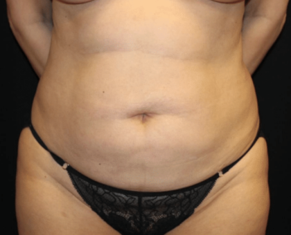 Tummy Tuck Before & After Patient #31639