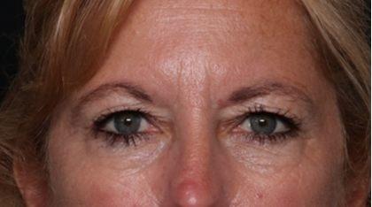 Blepharoplasty and Brow Lift Before & After Patient #31497