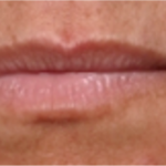 Lip Filler Before & After Patient #31689