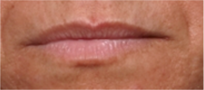 Lip Filler Before & After Patient #31689