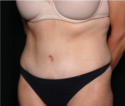 Tummy Tuck Before & After Patient #31832