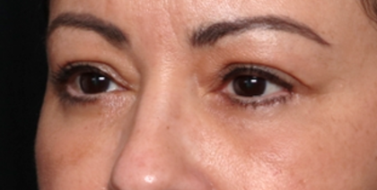 Blepharoplasty and Brow Lift Before & After Patient #31590