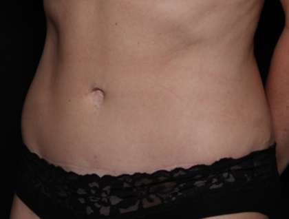 Tummy Tuck Before & After Patient #31601