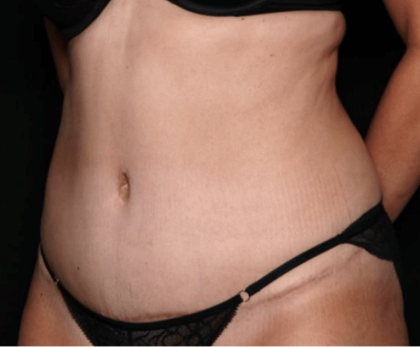 Tummy Tuck Before & After Patient #31639