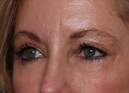 Blepharoplasty and Brow Lift Before & After Patient #31497