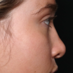 Rhinoplasty Before & After Patient #31578